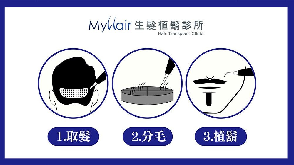 鬍型塑造如何評估？醫師解析植鬍療程與常見問題