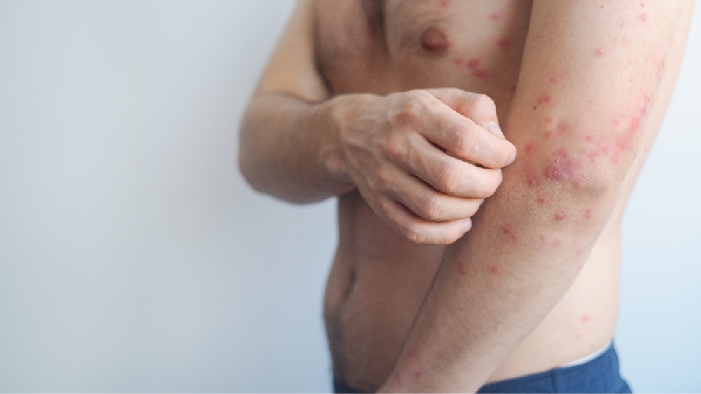 麻疹病毒的真面目是「免疫駭客」：可能強制破壞身體抵抗力