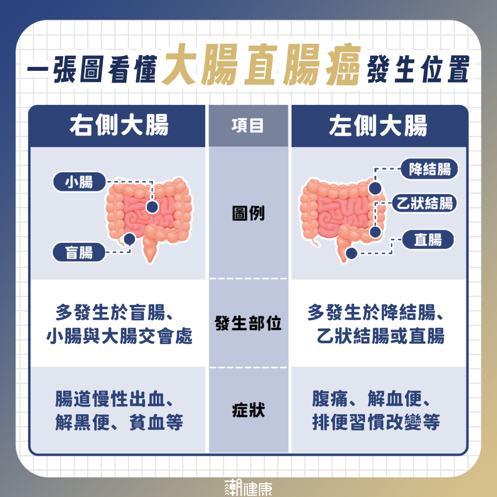 早期大腸癌幾乎無症狀！ 出現這些警訊要警覺
