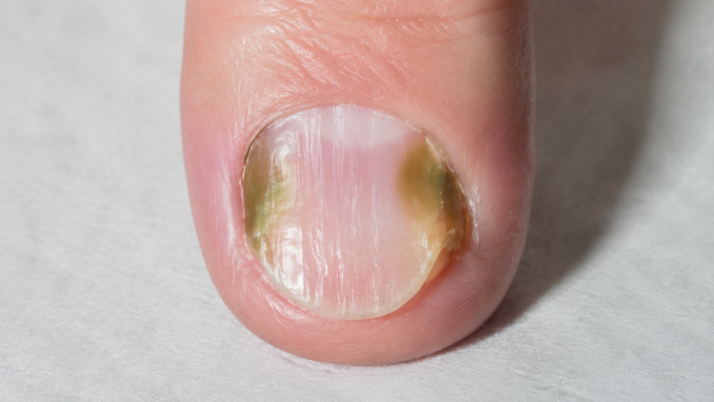 卸掉美甲發現指甲變綠？皮膚科醫師解析綠甲症候群