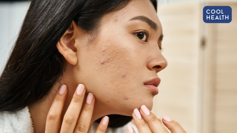 痘痘治了還是一直長？ 別急著亂換藥！醫：亂換藥「怎樣都會復發」