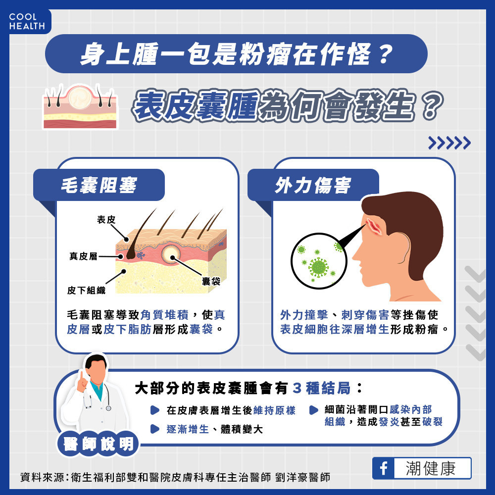 皮膚突然腫一塊是「粉瘤」發作？ 放著不管會自己消掉嗎？