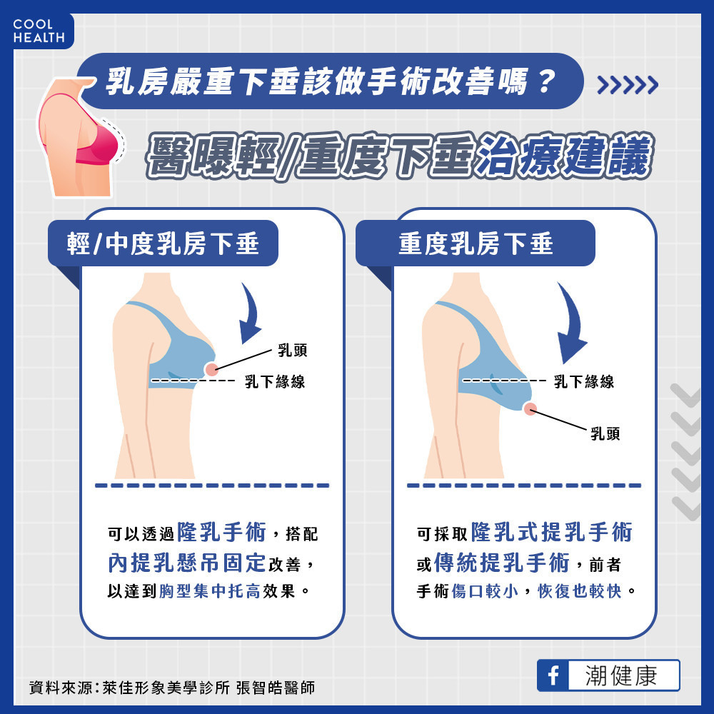 輕度和中度的乳房下垂,可以透過隆乳手術搭配內提乳的懸吊固定來改善,達到集中托高的效果,賦予患者感到滿意的乳房新外型。重度或以上程度的乳房下垂,傳統以提乳手術恢復高度並調整乳頭位置,但是皮膚切除的面積大、傷口明顯且術後乳房美觀不足。而現今的隆乳式提乳手術,在提乳同時也置入矽膠,患者不僅可以擁有較豐滿的乳房,切除的皮膚組織少,傷口也較小,恢復比較快,方方面面都兼顧到,才能讓女性朋友擁有美好雙峰。 輕度和中度的乳房下垂,可以透過隆乳手術搭配內提乳的懸吊固定來改善,達到集中托高的效果,賦予患者感到滿意的乳房新外型。重度或以上程度的乳房下垂,傳統以提乳手術恢復高度並調整乳頭位置,但是皮膚切除的面積大、傷口明顯且術後乳房美觀不足。而現今的隆乳式提乳手術,在提乳同時也置入矽膠,患者不僅可以擁有較豐滿的乳房,切除的皮膚組織少,傷口也較小,恢復比較快,方方面面都兼顧到,才能讓女性朋友擁有美好雙峰。