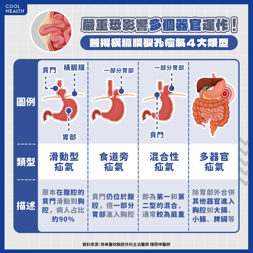 最多影響5個器官運作！ 醫揭「橫膈膜裂孔疝氣」四大類型