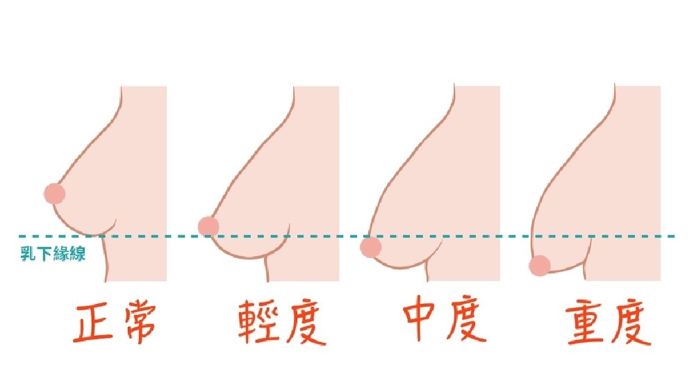 萊佳形象美學診所張智皓醫師指出，許多女性在產後為何會面臨乳房萎縮、外擴或下垂的情況。