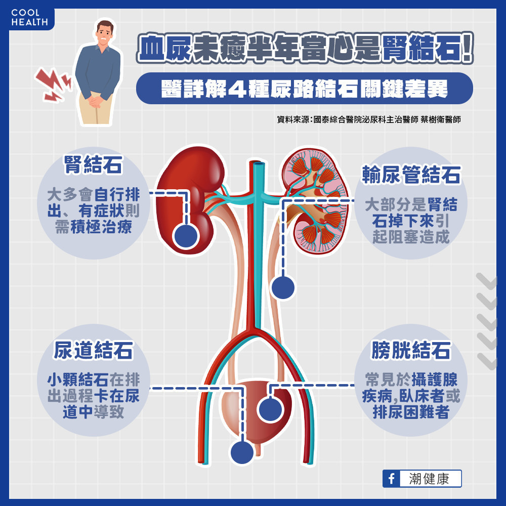 尿路結石可能發生於哪些部位？  用影像學檢查也難以發現？