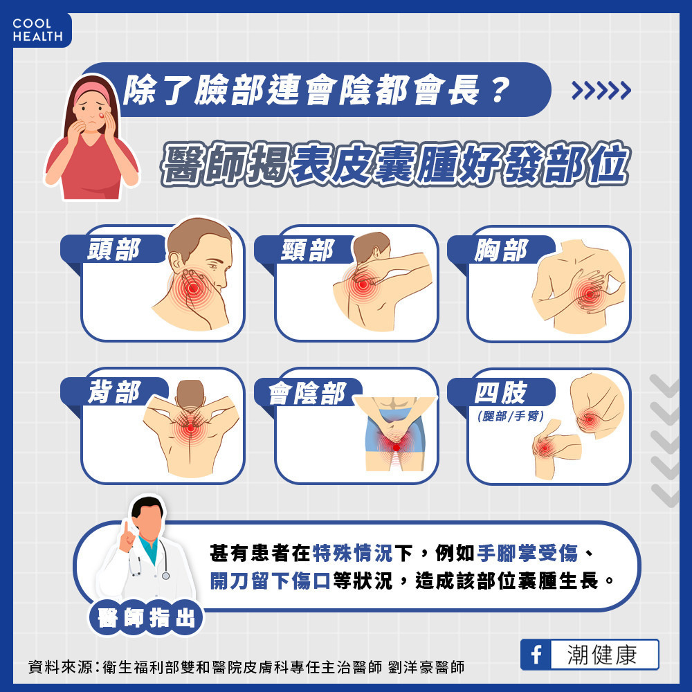 粉瘤爆發期有「季節之分」？  除了臉部連「會陰」都可能會長？