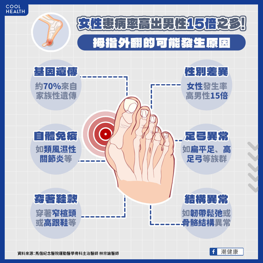 牽一「指」動全身！  拇指外翻的風險族群有哪些？