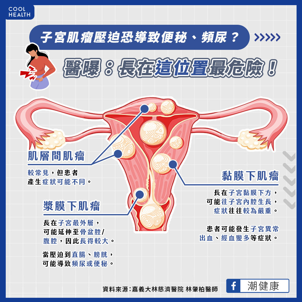 子宮肌瘤跟體質有關？  長在哪個位置最危險？