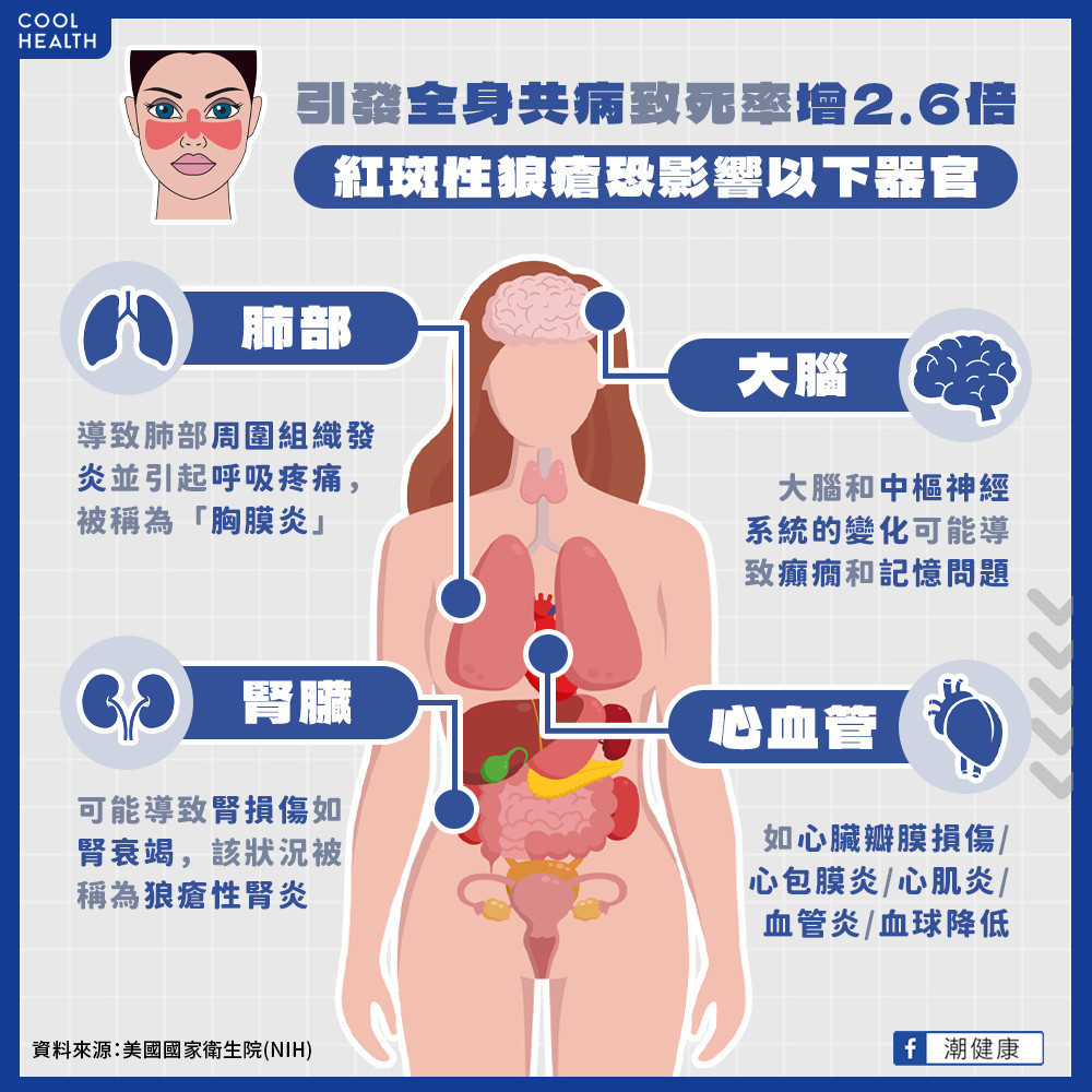 紅斑性狼瘡引發全身共病  醫示警：致死率恐增加2.6倍