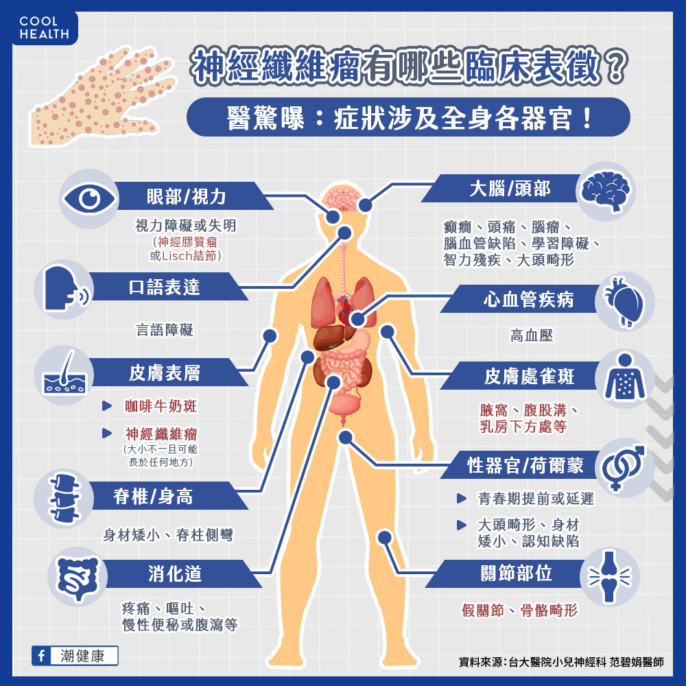 莫名腹痛與脊椎側彎？  當心體內潛藏「神經纖維瘤」