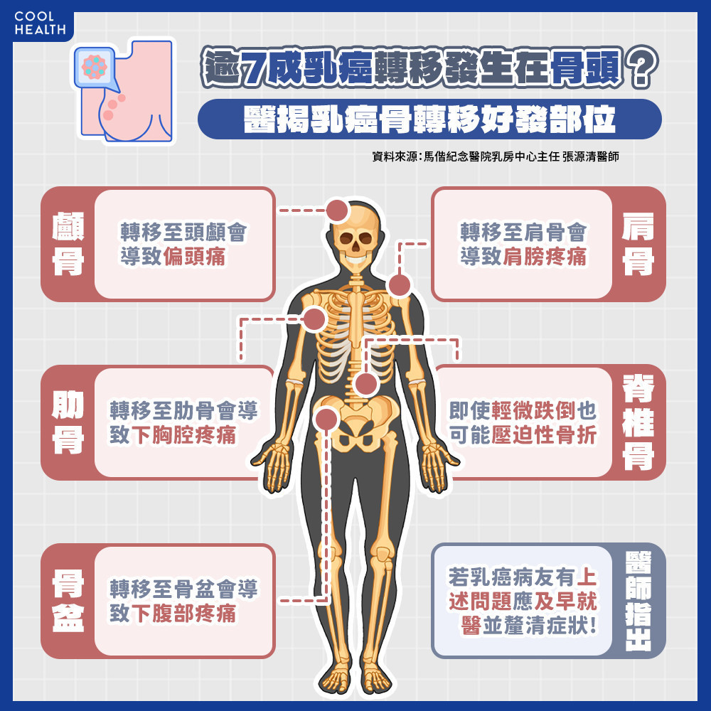 逾7成乳癌轉移發生在「骨頭」？ 女性荷爾蒙下降是一大警訊