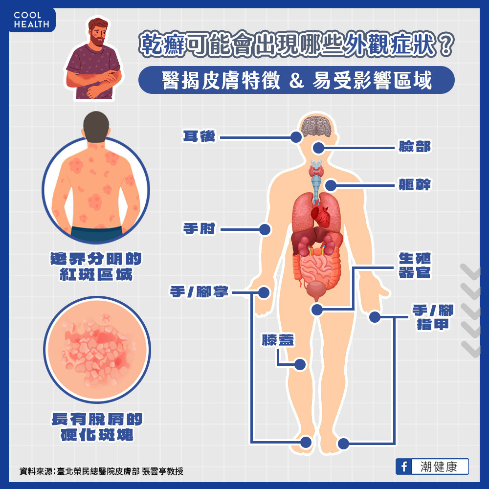 乾癬可能會出現哪些外觀症狀？  醫揭皮膚特徵、易受影響區域