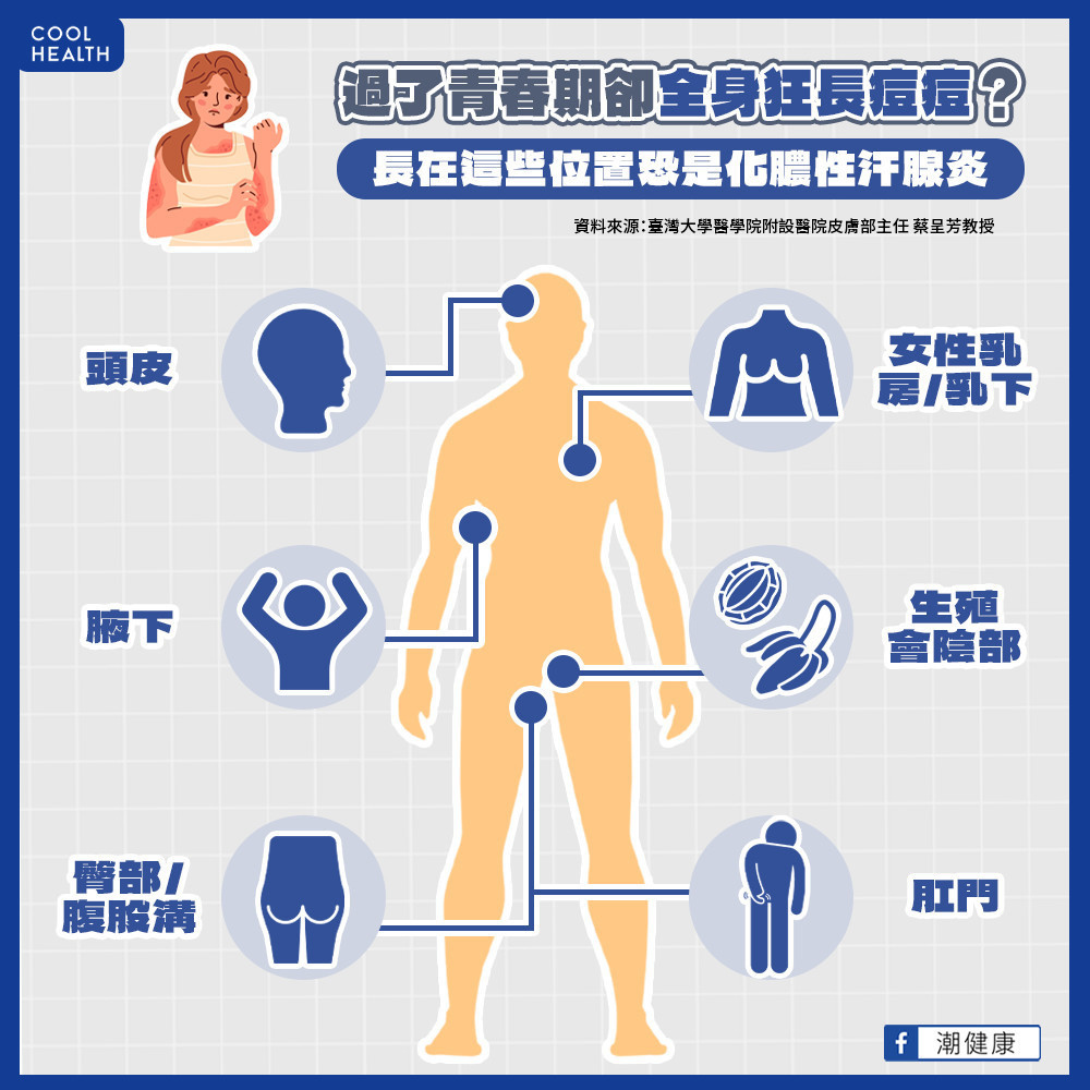 化膿性汗腺炎確診需耗費7.2年？  醫：病識感低落恐成為誤診危機！