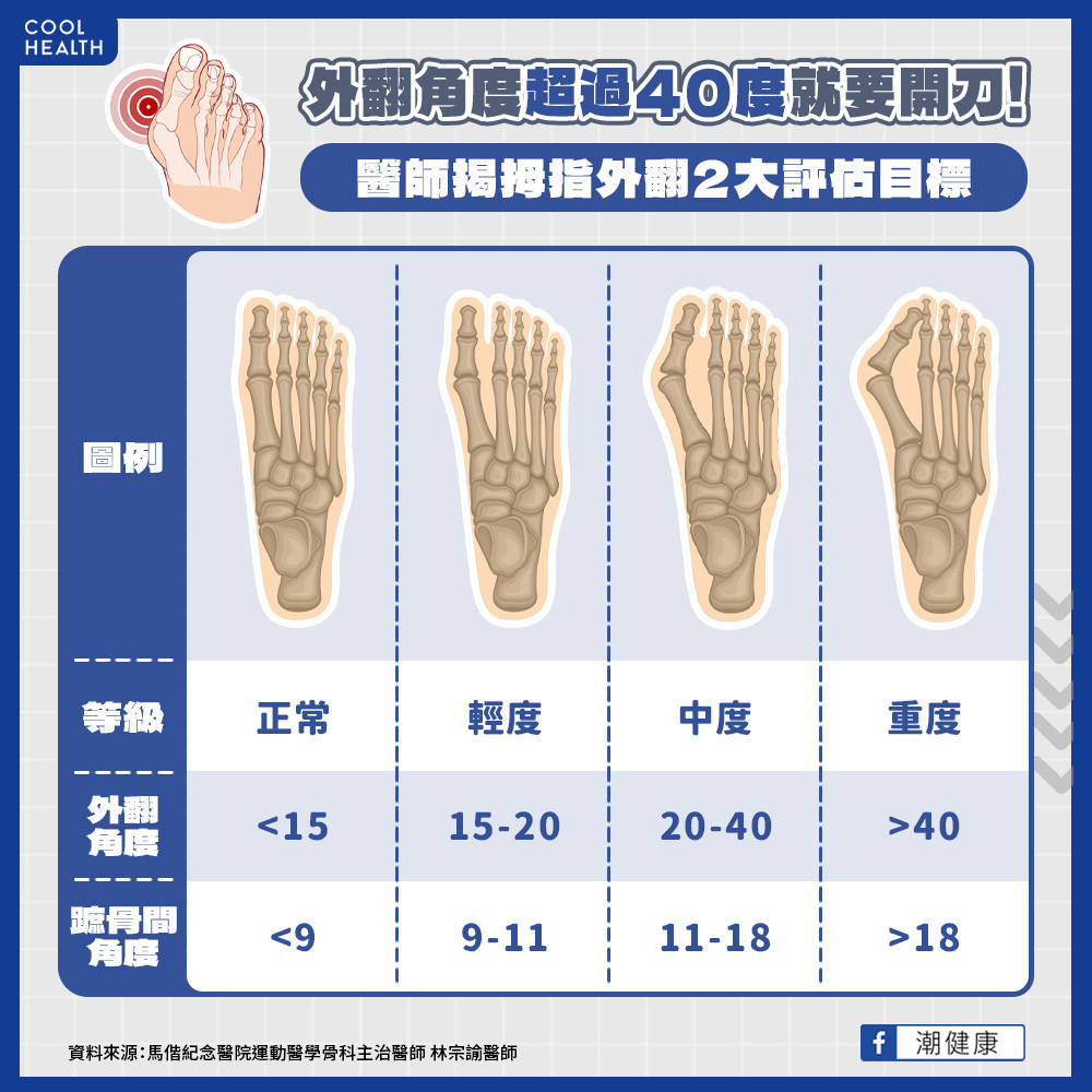 拇指外翻的臨床定義為何？  外翻角度超過40度就該動刀？