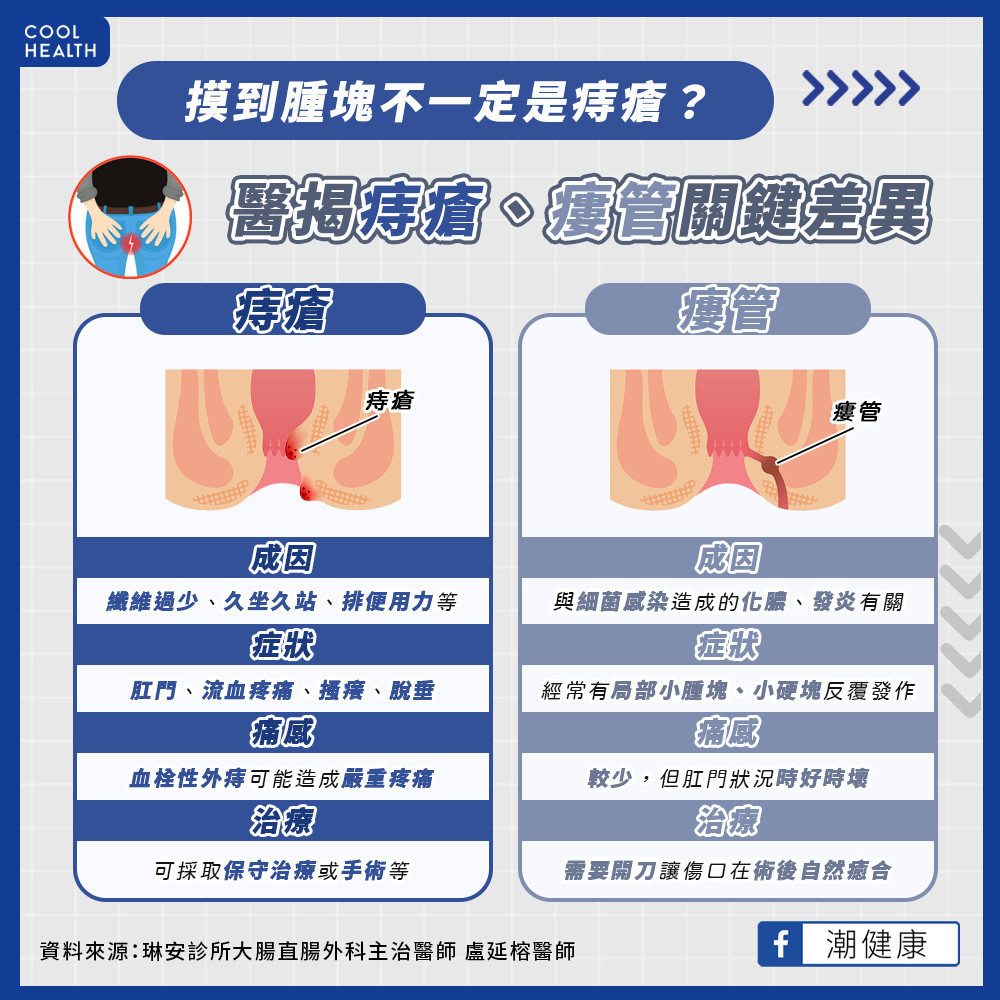 摸到腫塊不一定是痔瘡？  瘻管、痔瘡治療差異